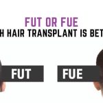 FUE vs. FUT: Which Is the Better Hair Transplant Method?