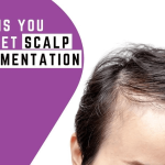 Five Reasons You should get Scalp Micropigmentation Treatment