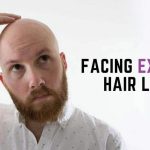Extreme Hair Loss?
