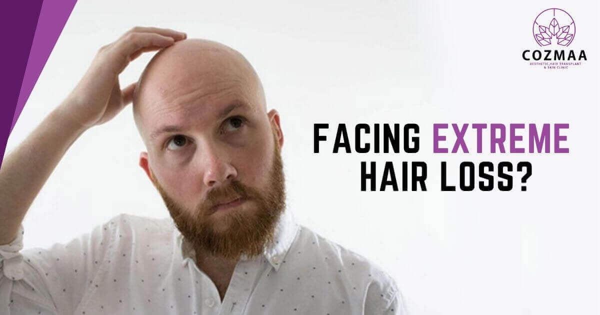 Extreme Hair Loss?